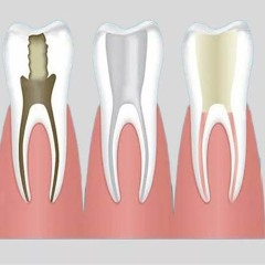 Painless Dentistry in Gurgaon And Painless Root Canal Treatment In India