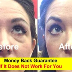Best What Is The Non Surgical Treatment For Eye Bags Reviews