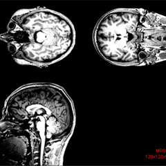 Neurological Disorder