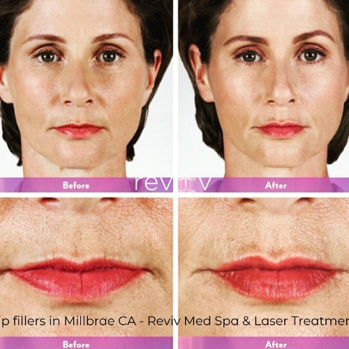 Lip fillers in Millbrae CA - Reviv Med Spa & Laser Treatment