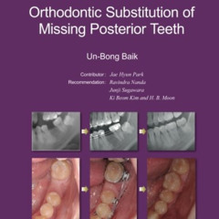 [FREE] KINDLE 💞 Molar Protraction:: Orthodontic Substitution of Missing Posterior Te