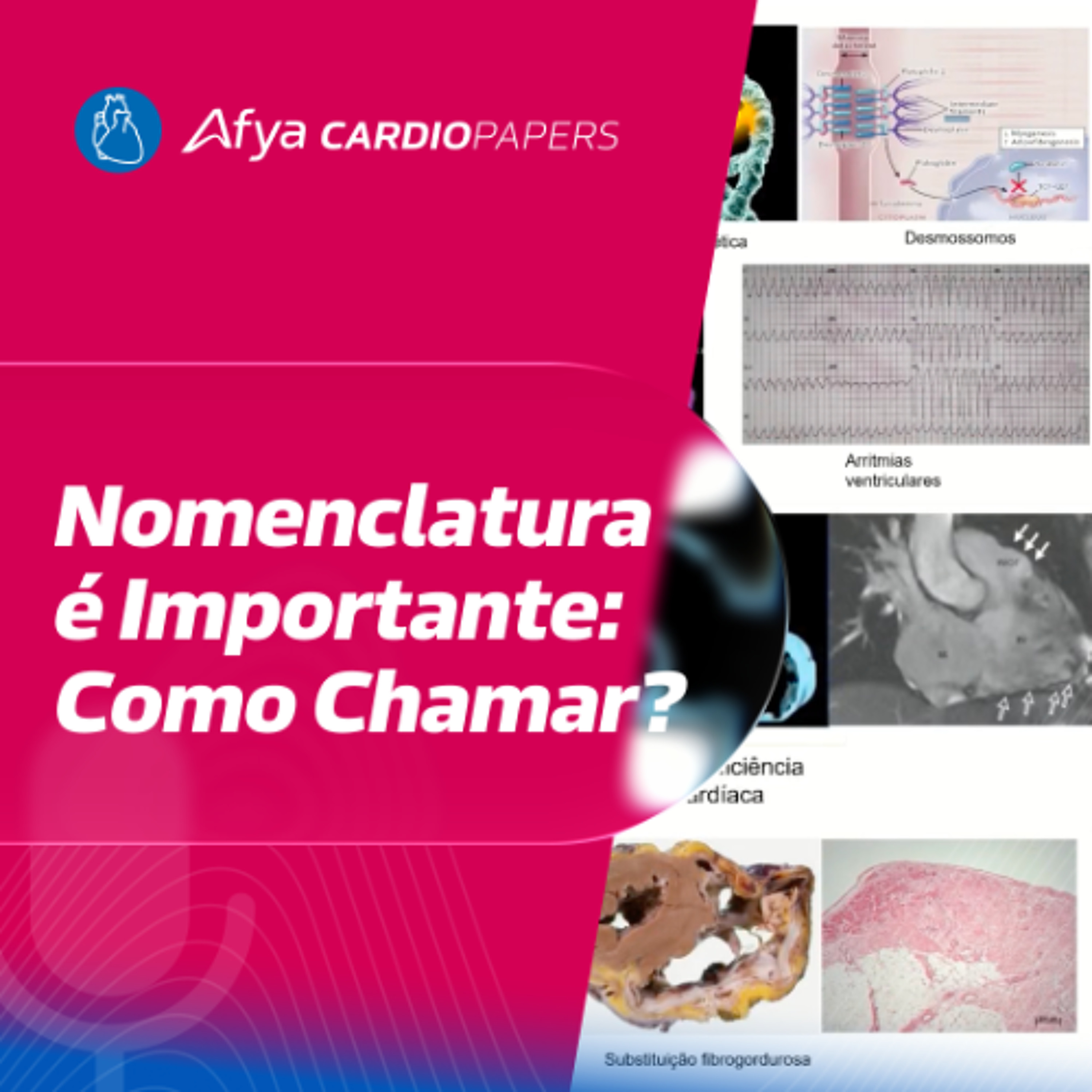 Cardiomiopatia Arritmogênica: A Terminologia Correta