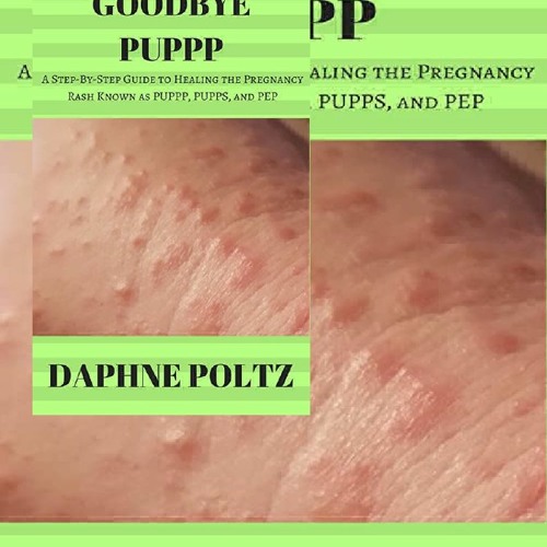 Audiobook Goodbye PUPPP: A Step-by-Step Guide to Healing the Pregnancy Rash Known as PUPPP, PUPPS, a