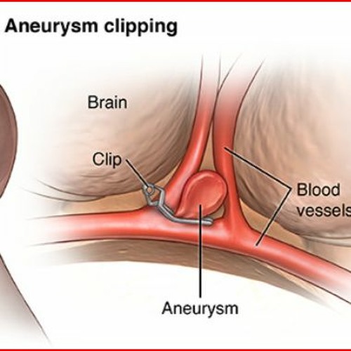 Stream Episode Brain Aneurysm Clipping By Neuro Wellness Podcast 