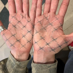 palms of my hands prod injurie