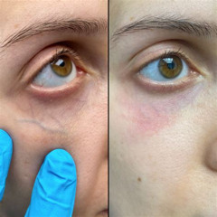 Best Under Eye Vein Laser Treatment Reviews