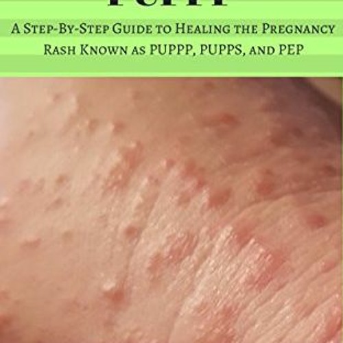 ✔️ [PDF] Download Goodbye PUPPP: A Step-by-Step Guide to Healing the Pregnancy Rash Known as PUP