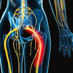 Sciatica