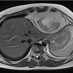 Case Report: Intrathoracic Synovial Sarcoma with BRAF V600E Mutation