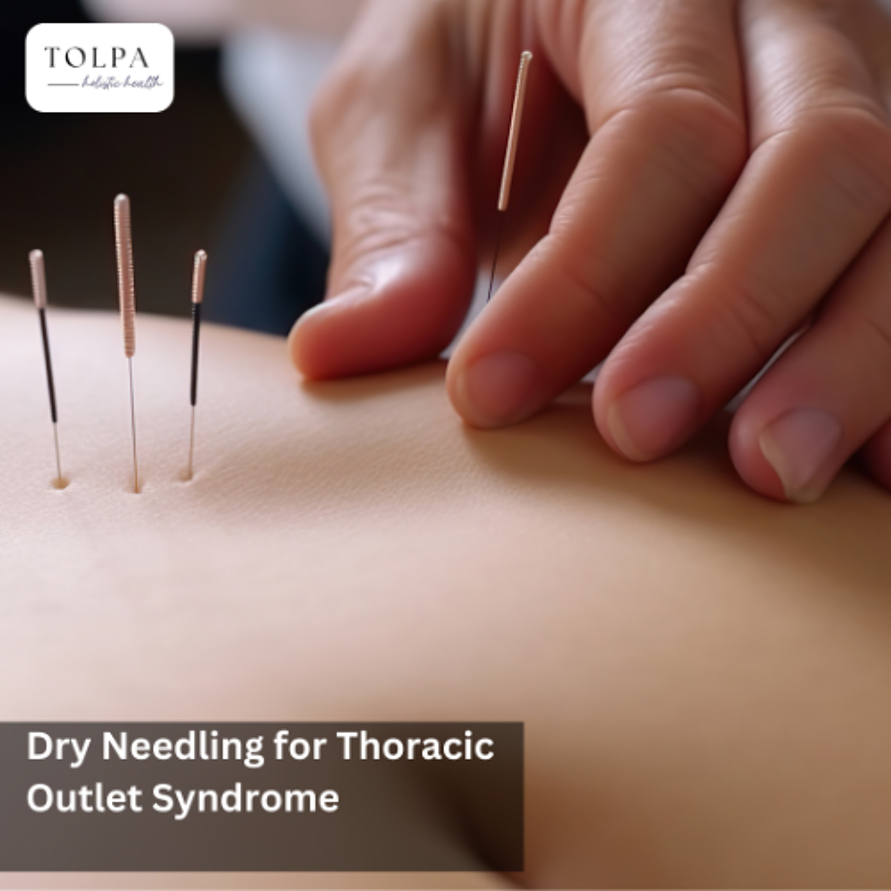 Dry Needling for Thoracic Outlet Syndrome