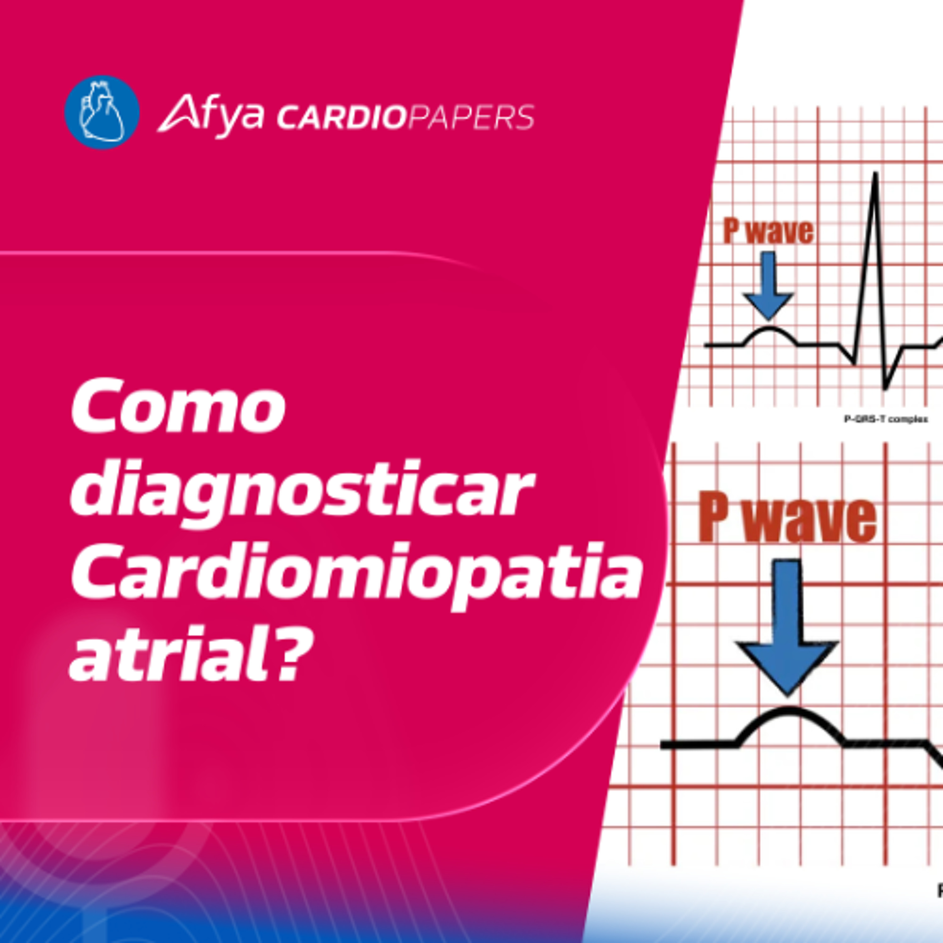 Cardiomiopatia atrial – Critérios Diagnósticos