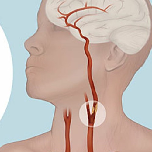 Stream Carotid Artery Stenosis Remedy Remove Plaques in Arteries