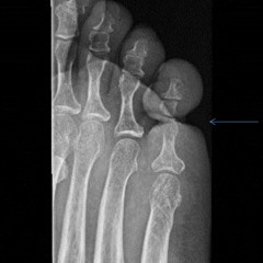 [Passages] Santé Campus - #48 Le syndrome d'Ainhum