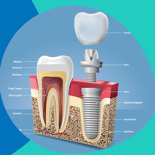 Stream What Is The Process Of Endosteal Dental Implants by Teeth Care