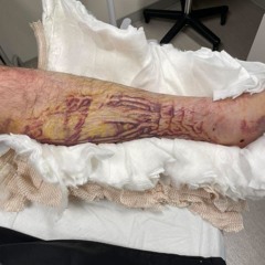 fracture