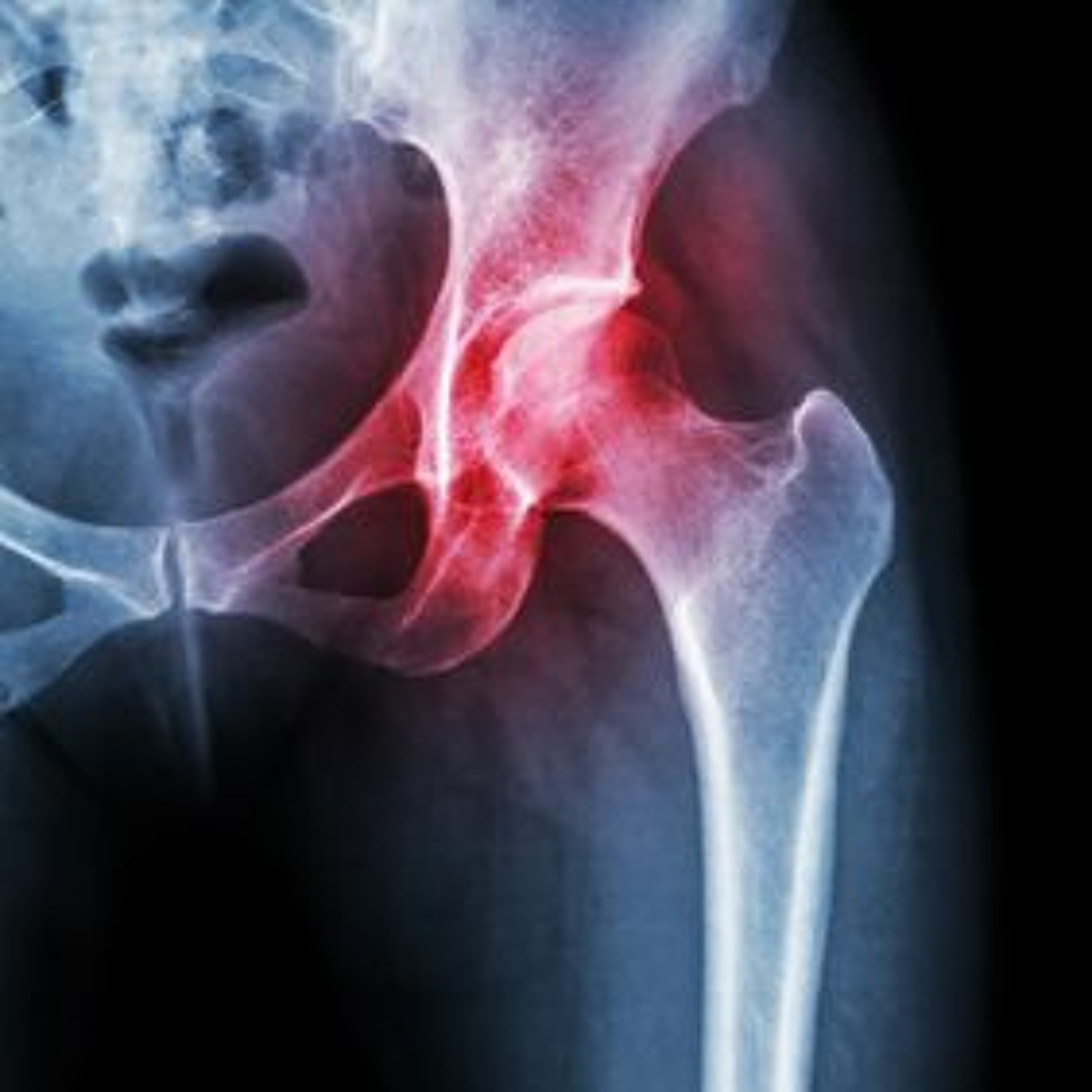 British Society for Rheumatology guidance, DMARD, steroid therapy and COVID19