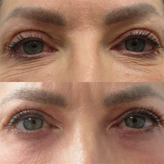 Best Co2 Treatment For Eyes Reviews