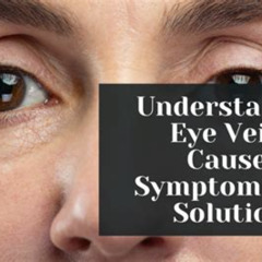Best Veins Around Eyes Treatment Reviews