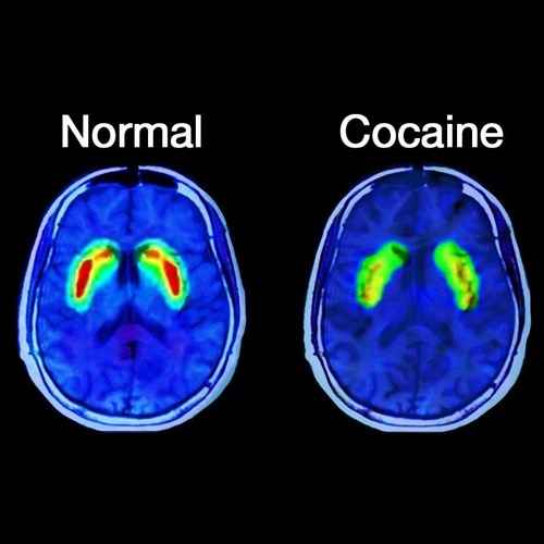 PinstripeK1ller-coke brain (prod. Ballmanee)