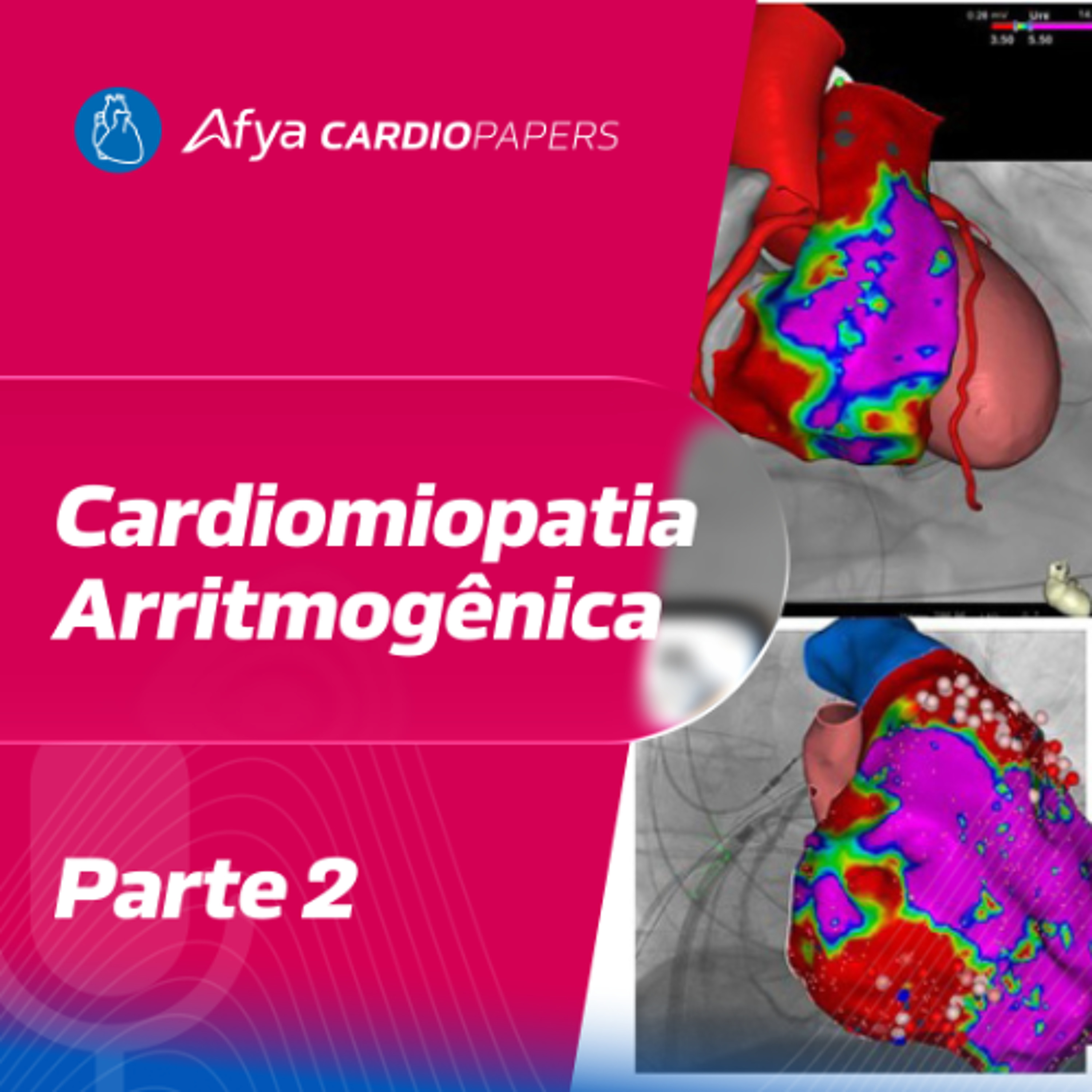 Cardiomiopatia Arritmogênica - Parte 2