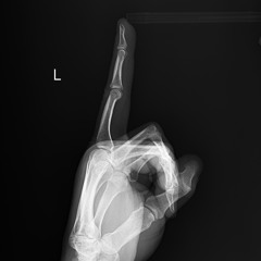 Piriketleri Kırmışlar