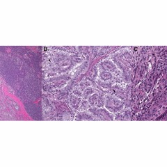 Genetic Alterations in Thyroid Cancer: Resistance to BRAFi and Anaplastic Transformation