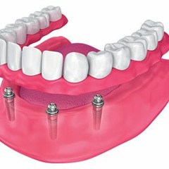 Complete Dental Implants Cost In Ellicott City