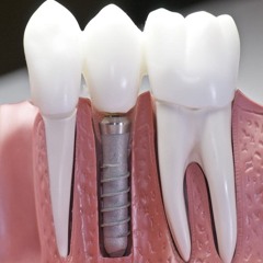 Dental Implants in Campbelltown: The Key to a Confident Smile