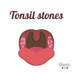#199 Tonsil stones, what are they and how do you get rid of them