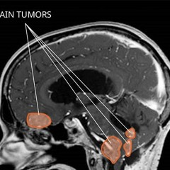 Choroid Cyst In Adults