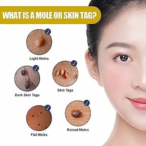 Stream Skin Tag Remover en Español by Skin Tag Remover en Español