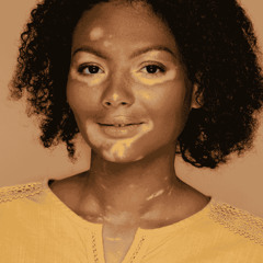 Understanding and Overcoming Vitiligo_ A Guide