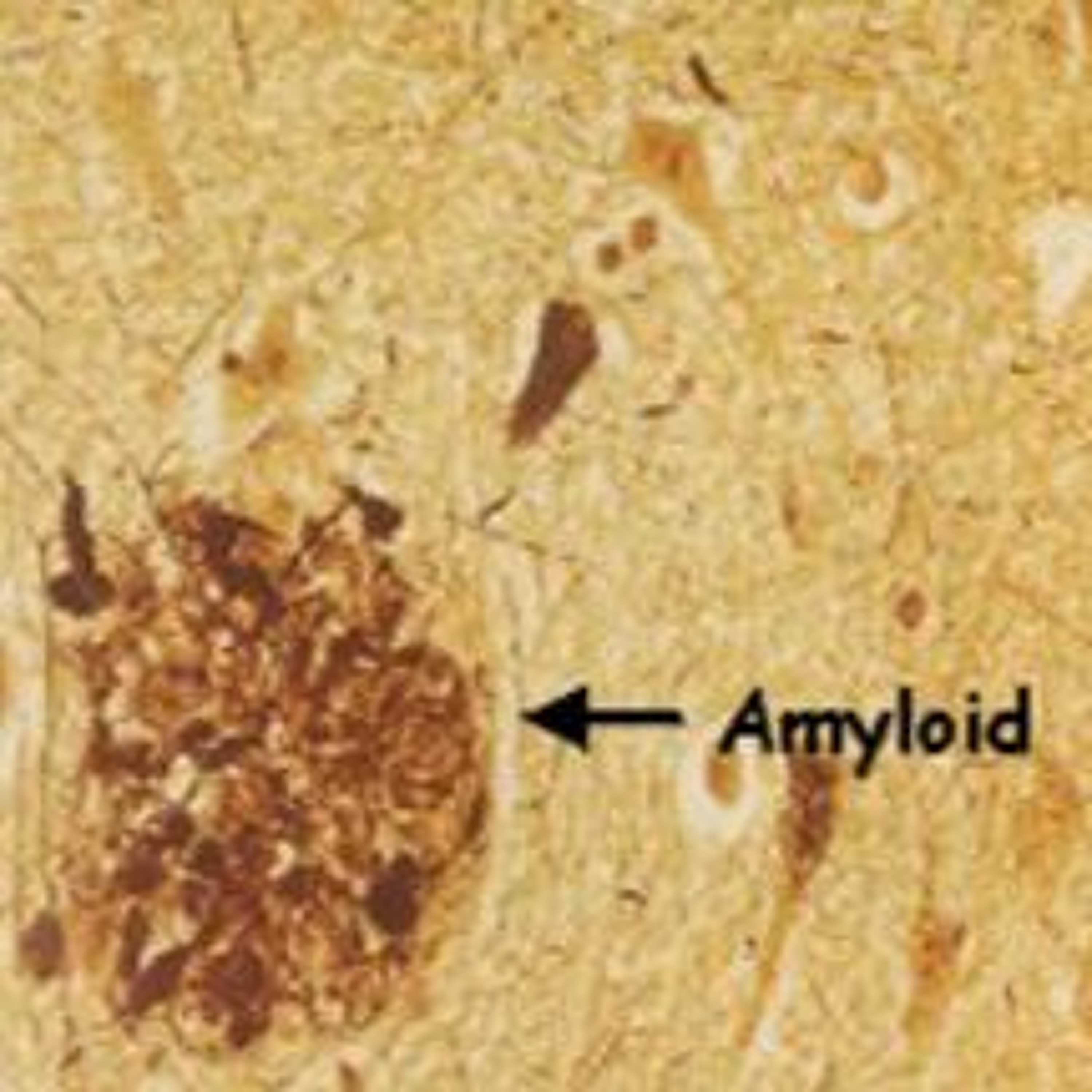 Alzheimer Life podden