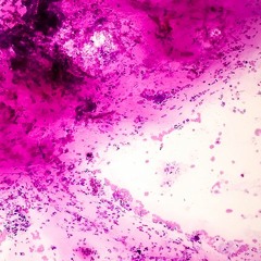 How a Receptor Boosts WNT Signals in Pancreatic Cancer