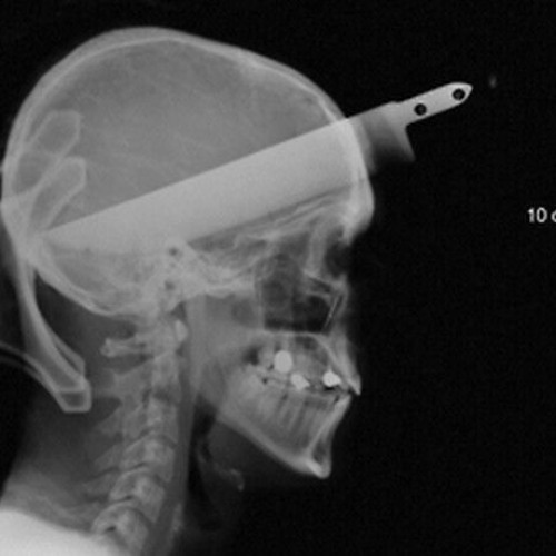 headache (all the time)