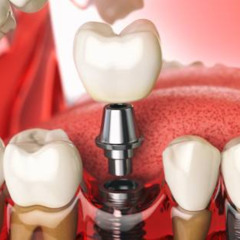 Top 5 Nutrition Tips After Dental Implants in Washington