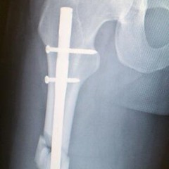 titanium_leg