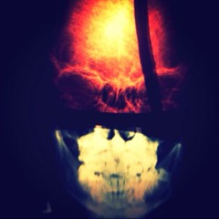 skullfracture101