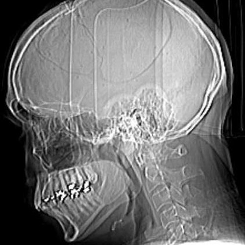 Hirntot - Aneurysma