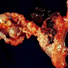 An Ectopic Pregnancy