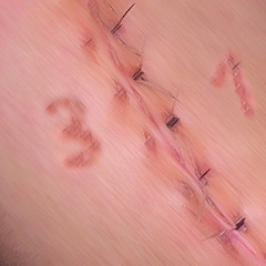 31 Stitches