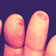 Your finger's blisters