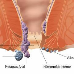 Hemoroide