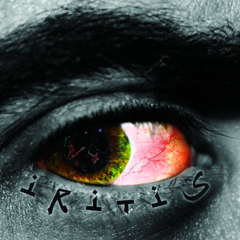 Iritis