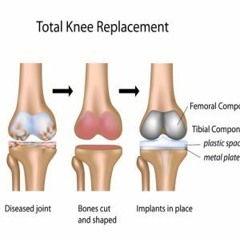 Stream Total Knee Replacement Music | Listen To Songs, Albums, Playlists  For Free On Soundcloud