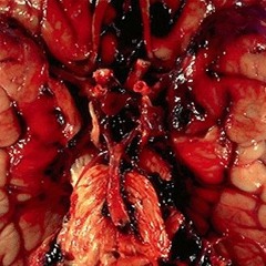 Brain Bleed