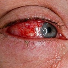 DJ Zapalenie Spojówek