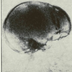 Lobotomia