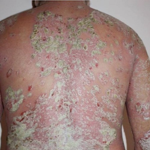 plaque psoriasis moderate to severe hogyan lehet eltávolítani a vörös foltokat az arcáról