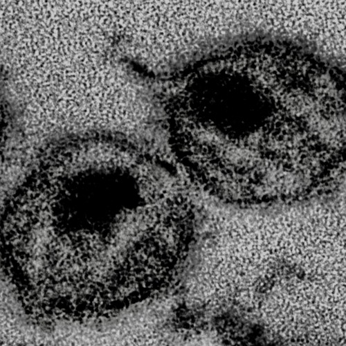 1. HIV - Nausea